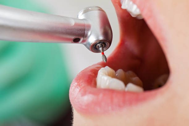 Best Emergency Tooth Extraction in Midway, UT